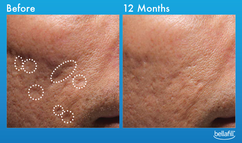Bellafill Acne scars the Woodlands Texas